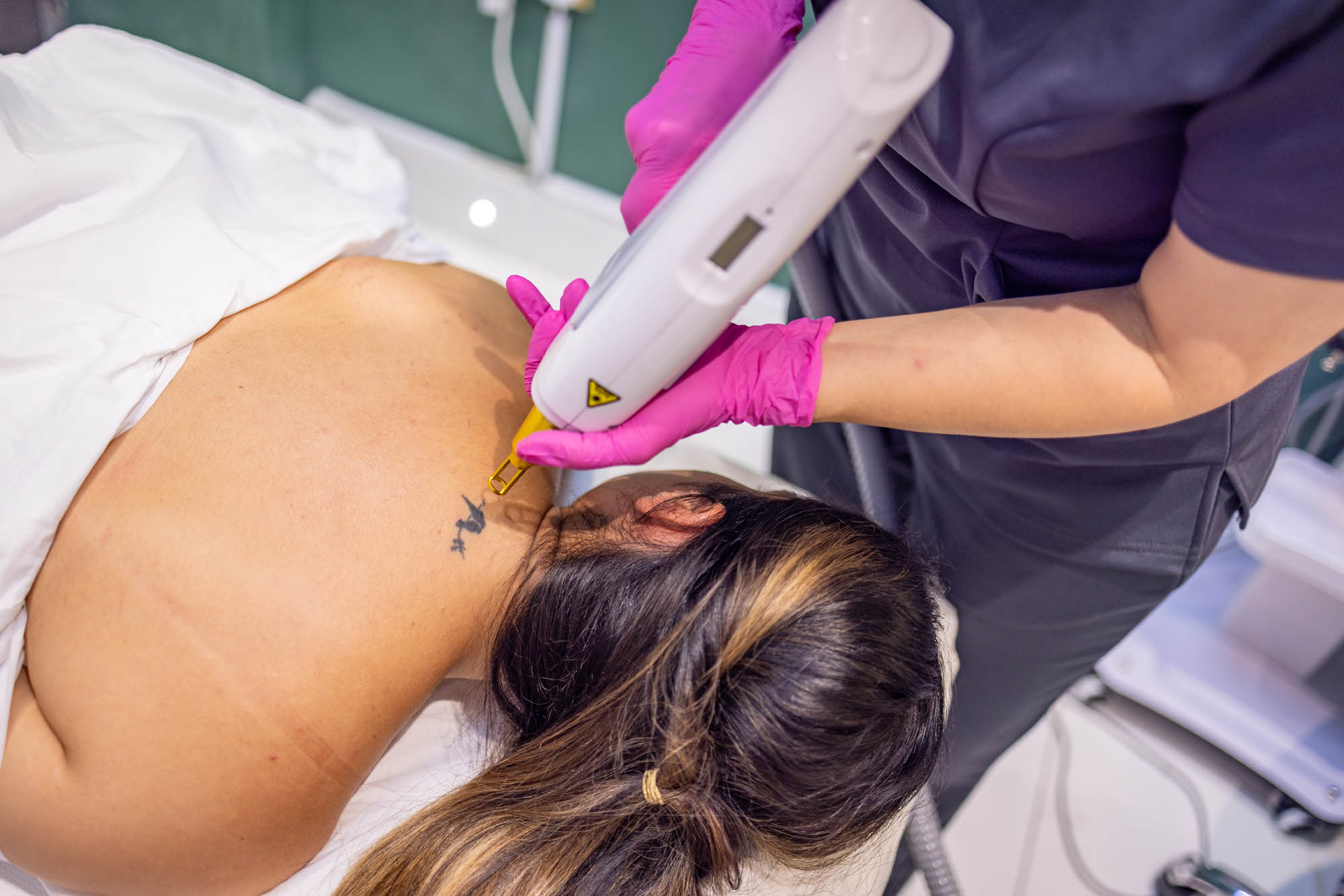 Tattoo Removal Eltham