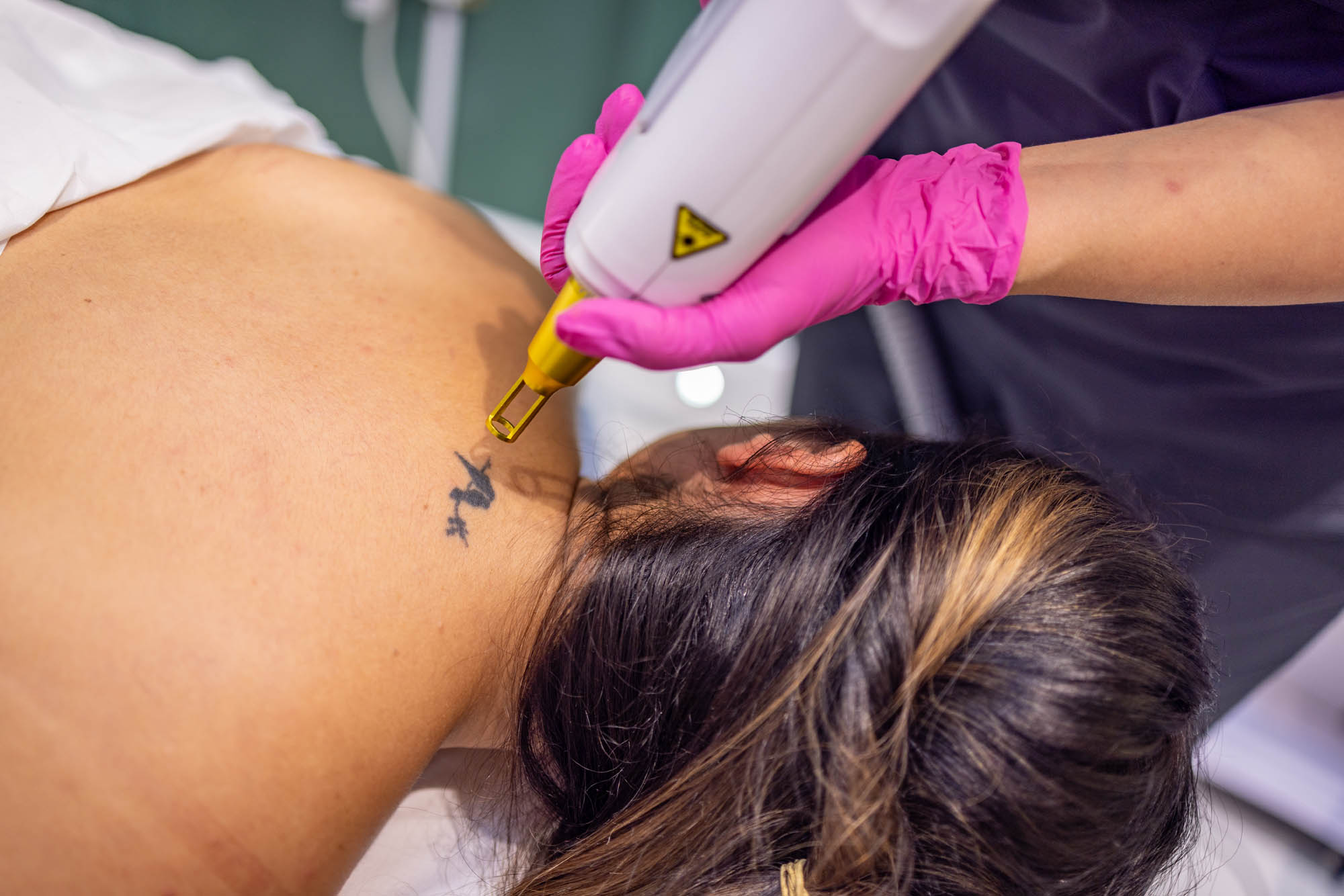 Tattoo Removal Eltham