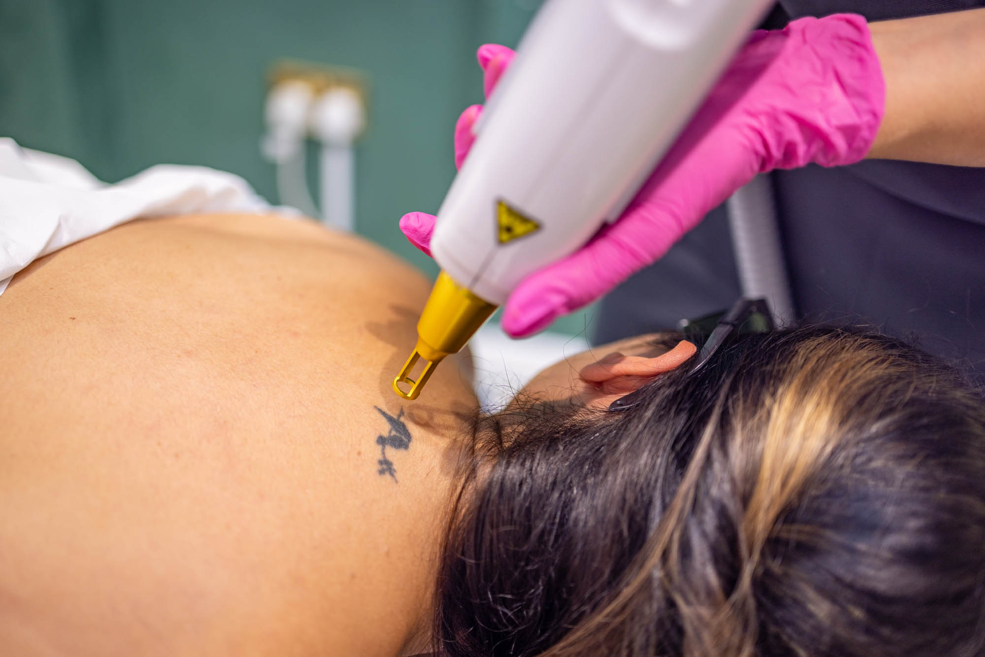 Tattoo Removal Eltham