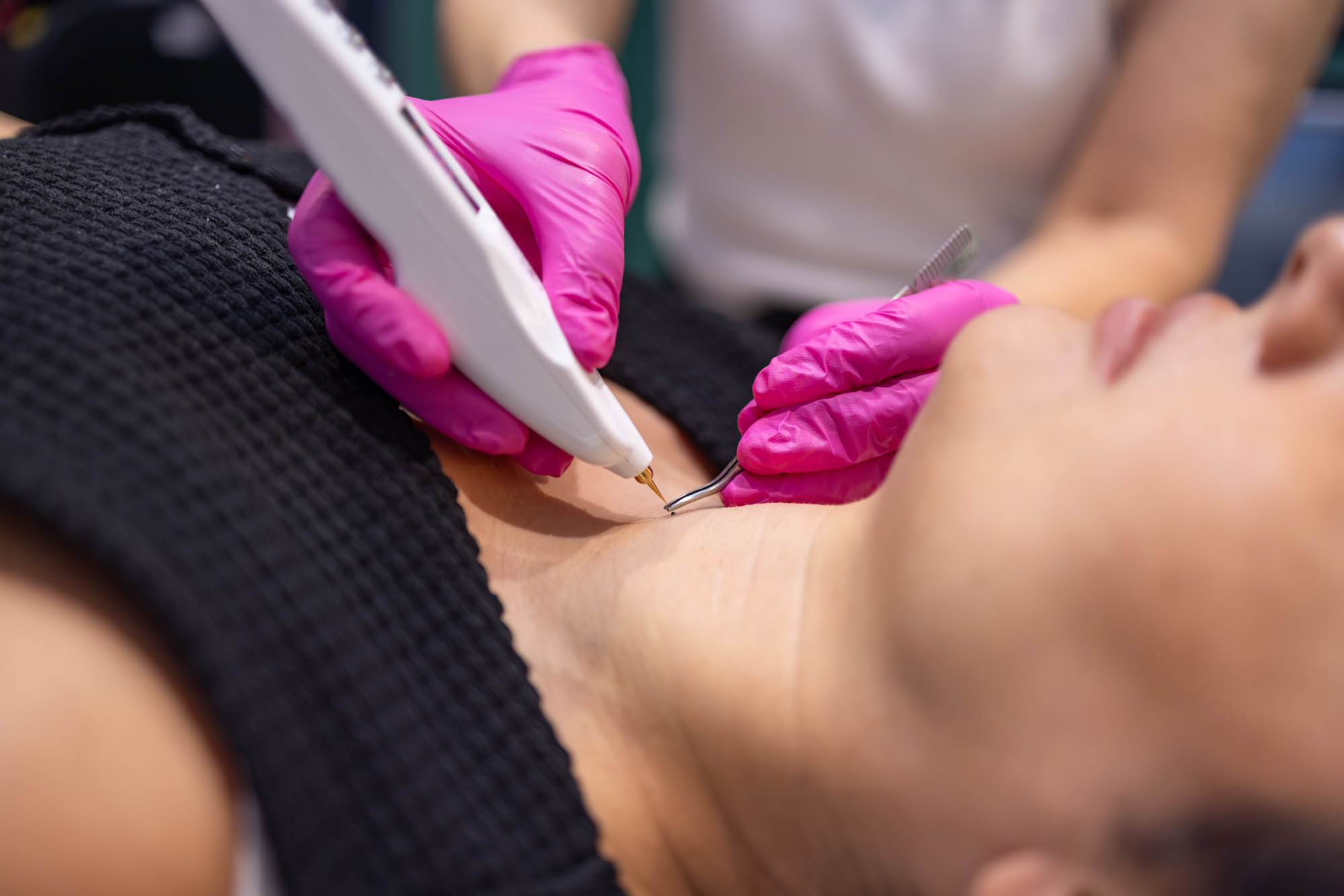Skin Tag Removal